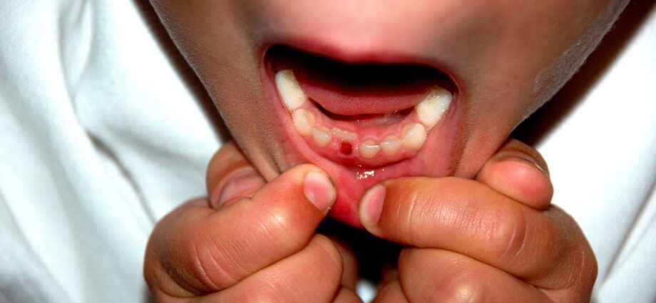 A baby&#8217;s milk tooth fell out: what to do, where to put the first tooth