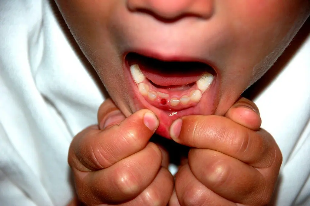 A baby&#8217;s milk tooth fell out: what to do, where to put the first tooth