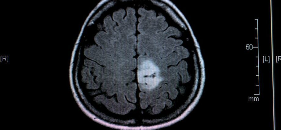 En hjernesvulst (hjernekræft)
