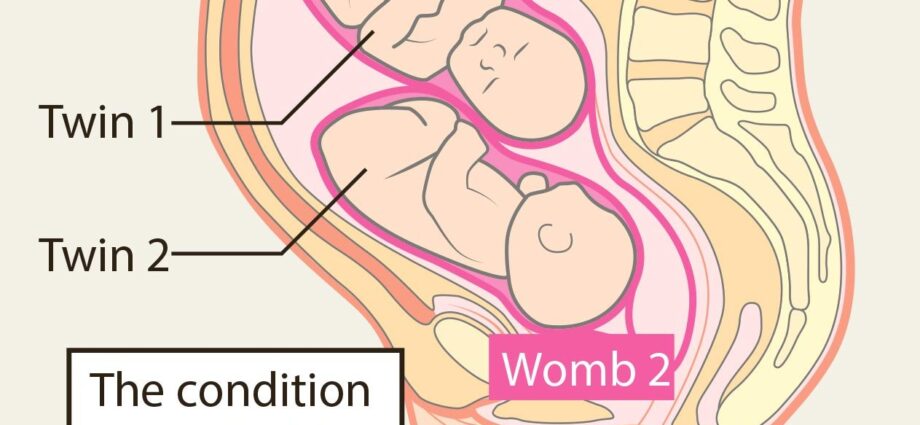 A girl with two uterus carried a baby without knowing about pregnancy