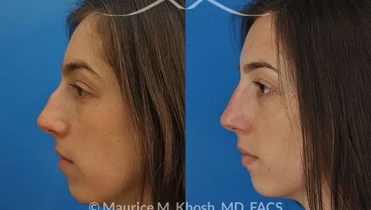 A hump on the nose: how to get rid of?