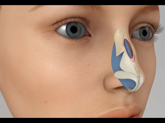 A humped nose: how to reshape? Video