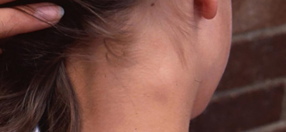 A lump on a child&#8217;s neck: what could it be, reasons