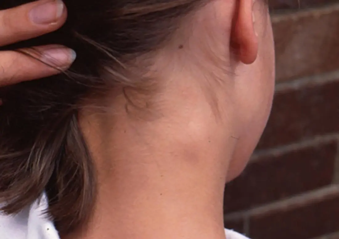 A lump on a child&#8217;s neck: what could it be, reasons