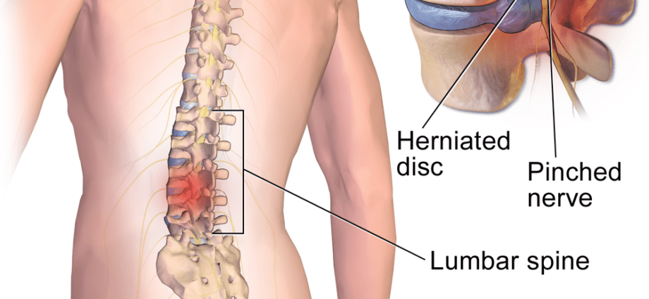 A pinched nerve in the back: what to do?