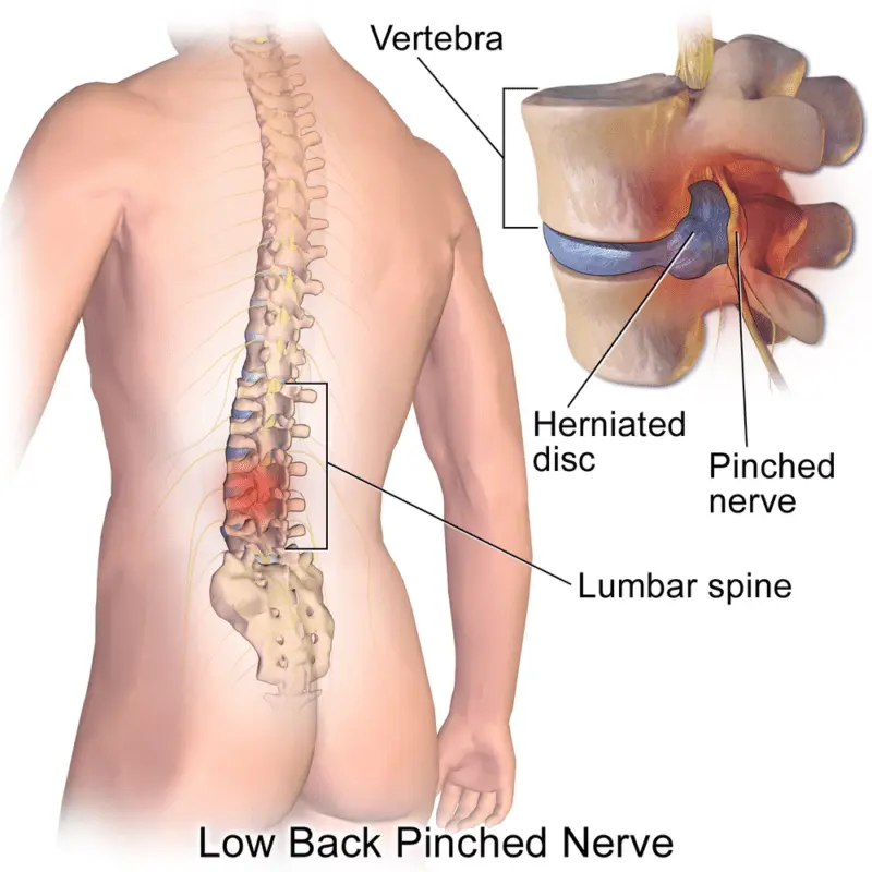 A pinched nerve in the back: what to do?