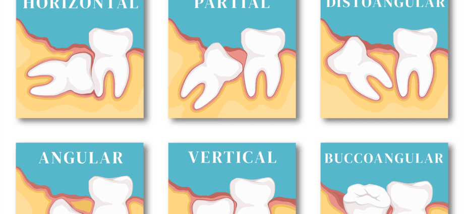 A wisdom tooth is cut during pregnancy, how to relieve pain