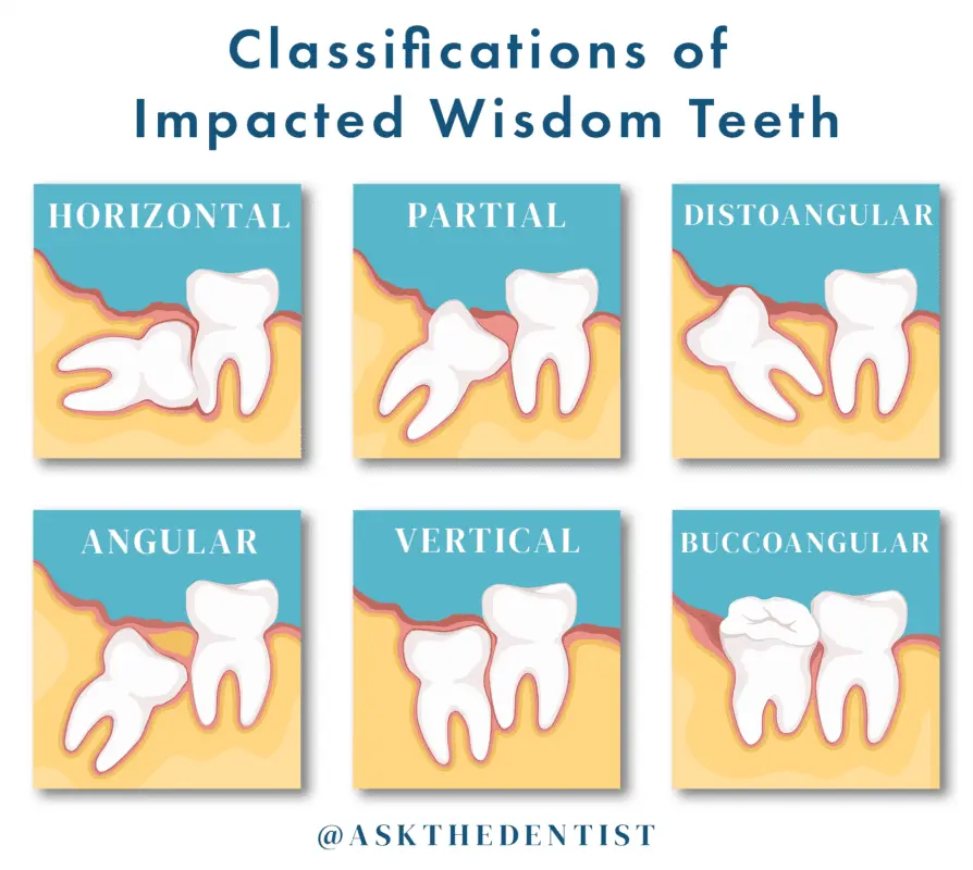 A wisdom tooth is cut during pregnancy, how to relieve pain