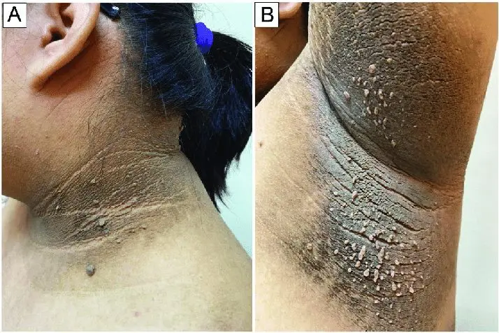 Acanthosis nigricans