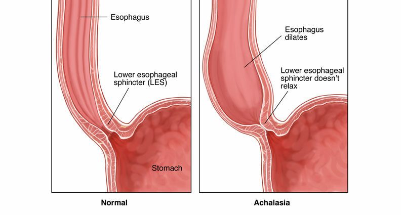 Achalasia: a h-uile càil mu achalasia esophageal
