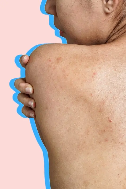 Acne marks on the back: how to get rid of? Video