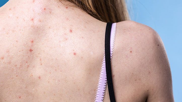 Acne on the back and shoulders: how to get rid of? Video