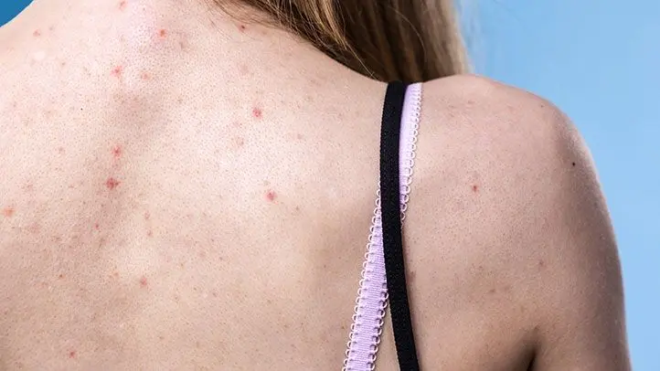Acne on the back and shoulders: how to get rid of? Video