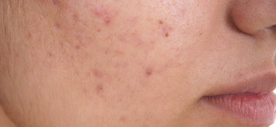 Acne on the face: causes and treatment. Video