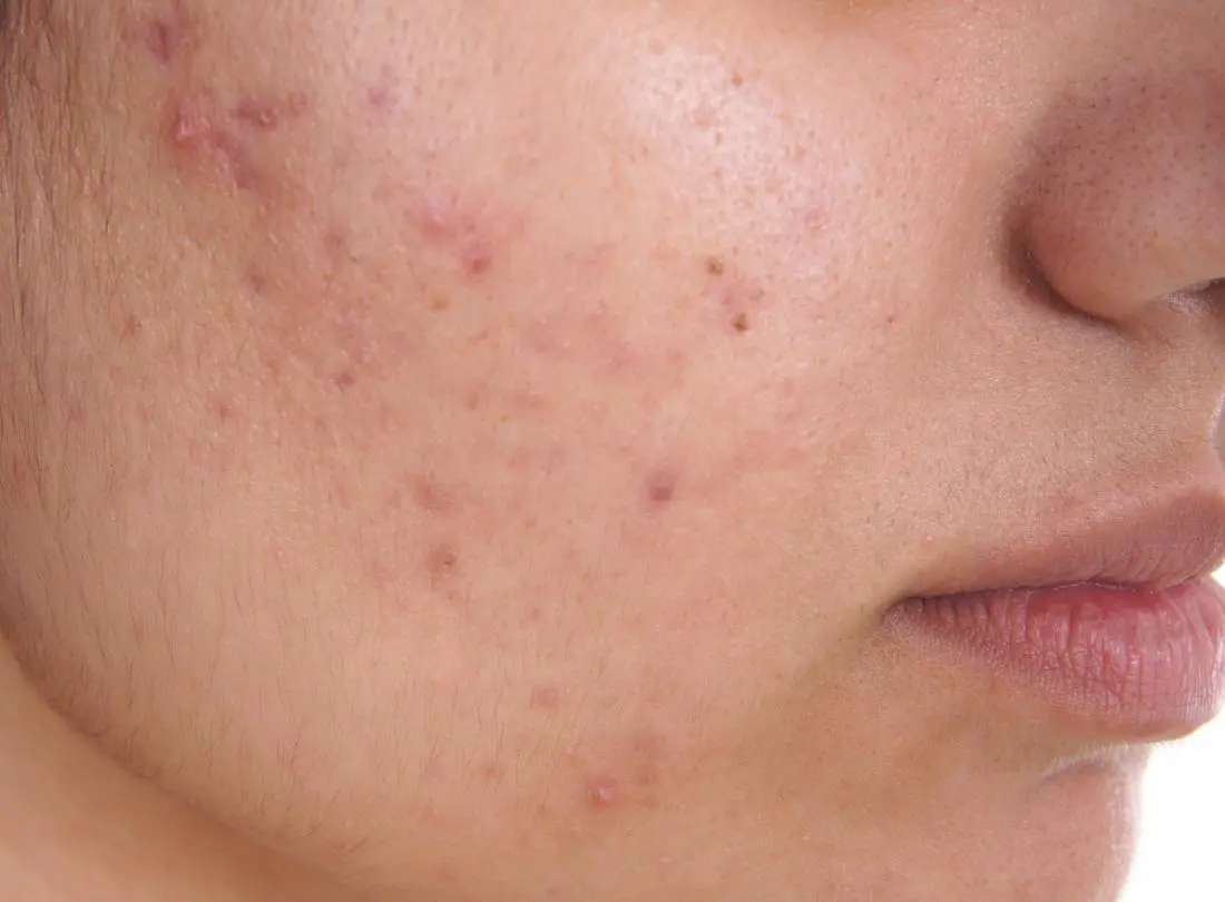 Acne on the face: causes and treatment. Video