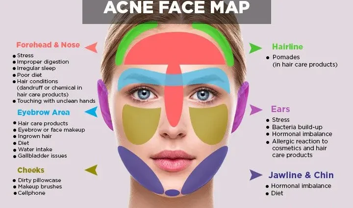 Acne on the face: diagnosis and treatment. Video