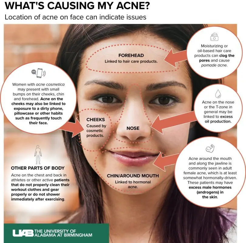 Acne on the face: why they appear in certain parts of the face