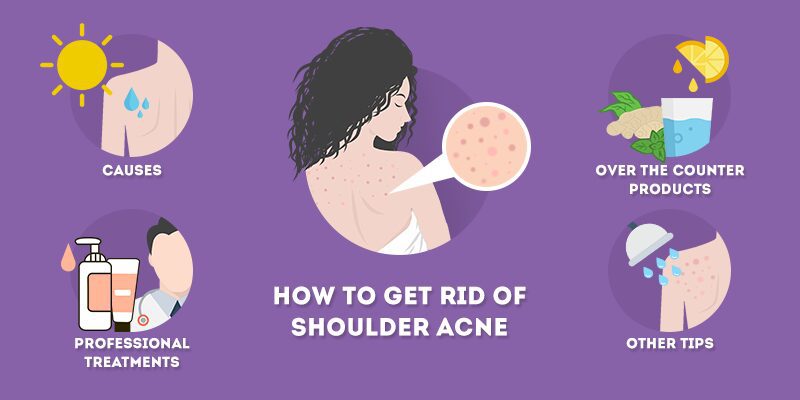 Acne on the shoulders: how to remove it? Video