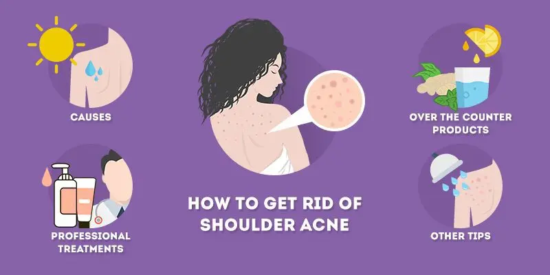 Acne on the shoulders: how to remove it? Video