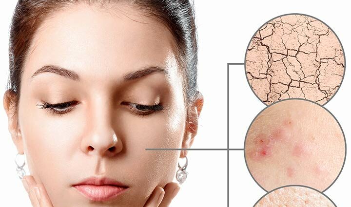 Acne on the skin: how to relieve redness? Video