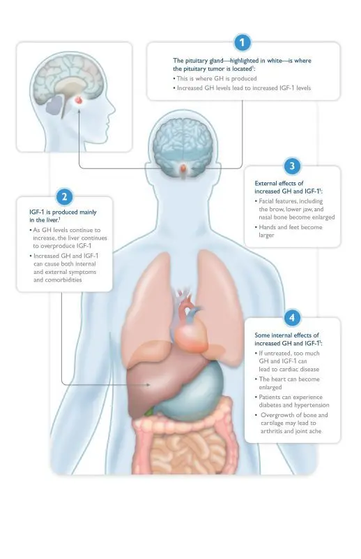 Acromegaly: sites of interest