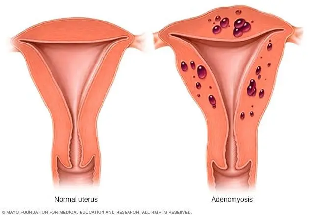 Adenomyosis