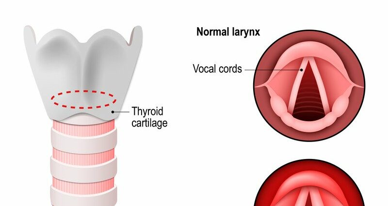 After coughing, the voice disappeared: how to treat