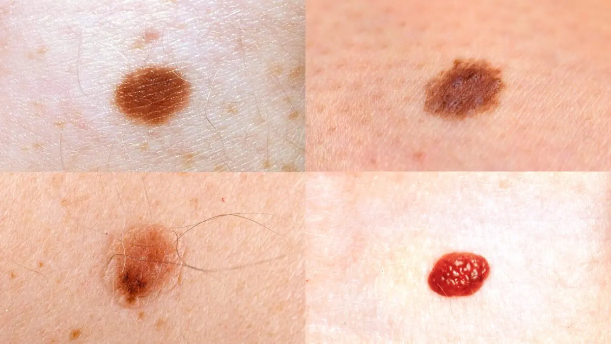 Aging of the body depends on moles