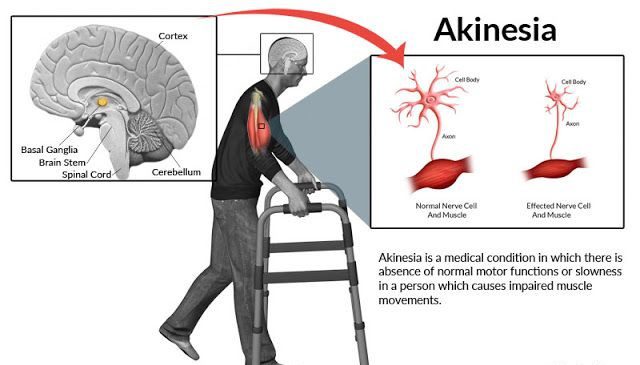 Akinesia: Definition, Causes, Treatment