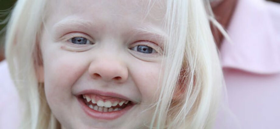 Albinisme: apa artinya menjadi albino?
