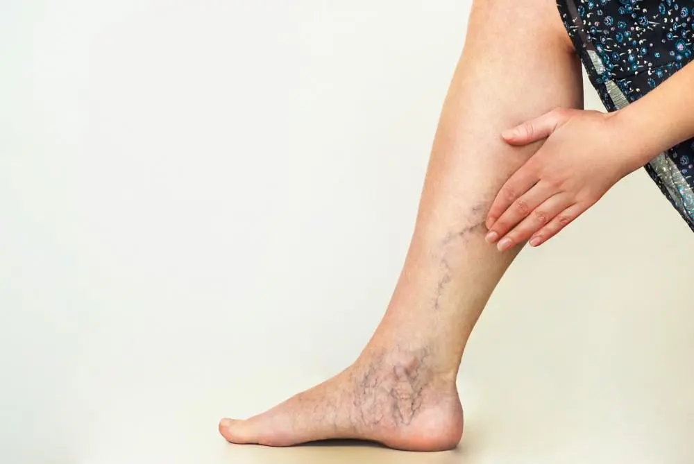 All about venous insufficiency