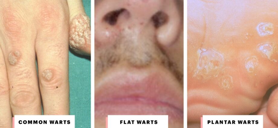 All about warts