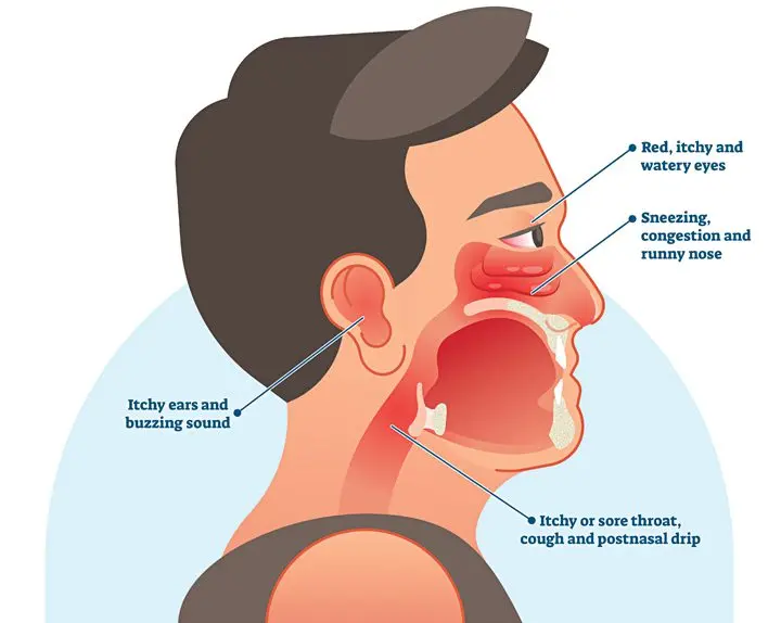 Allergic rhinitis &#8211; Our doctor&#8217;s opinion