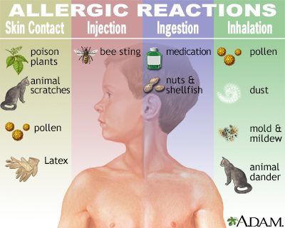 Allergii (riassuntu)