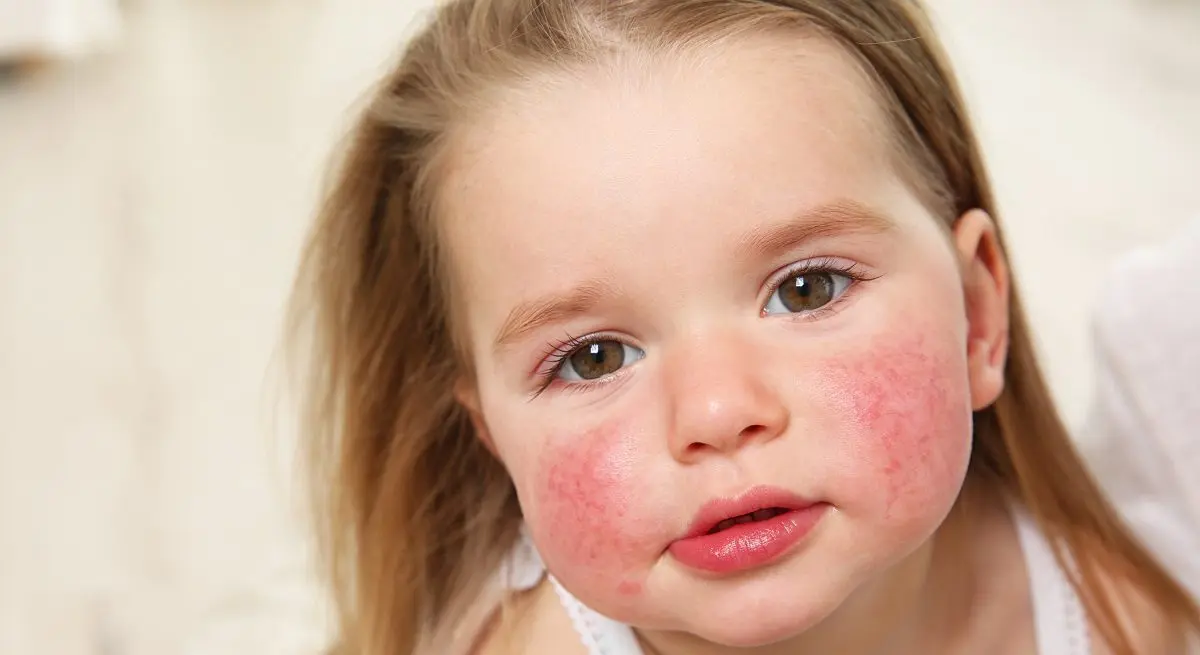 Allergy in children