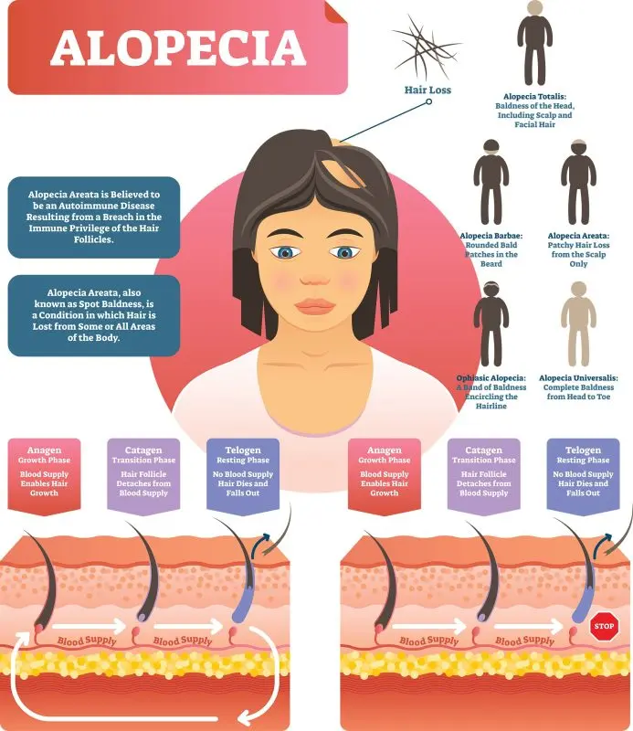 Alopecia: all you need to know about hair loss