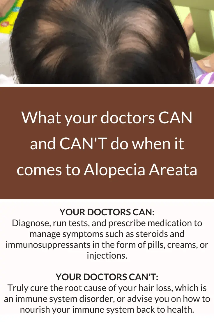 Alopecia areata &#8211; our doctor&#8217;s opinion