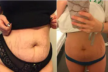 American woman makes $ 9000 by posting photos with stretch marks after childbirth