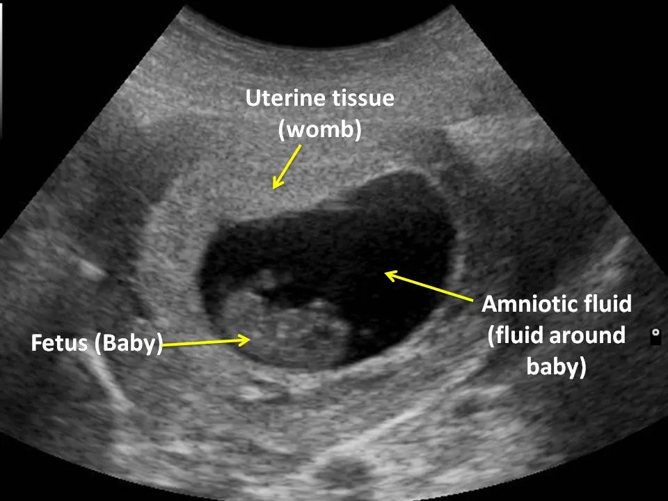 Amniotic hernia: ultrasound showed how the baby is trying to escape from the uterus