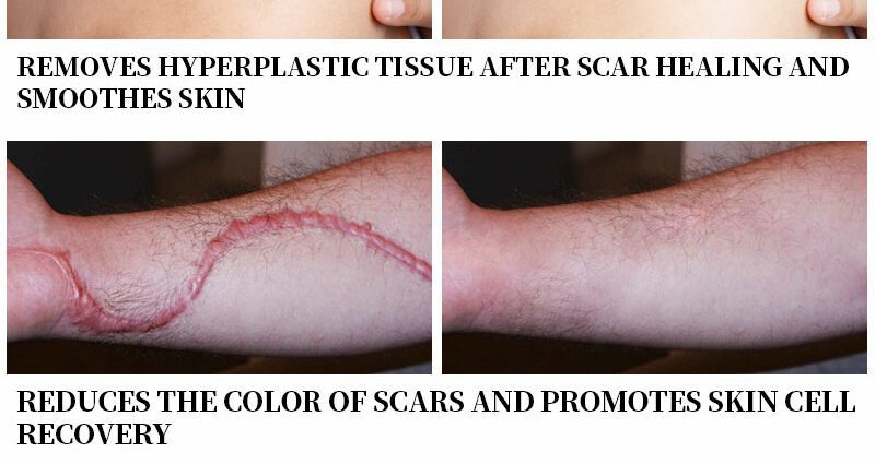 An effective anti-scar treatment