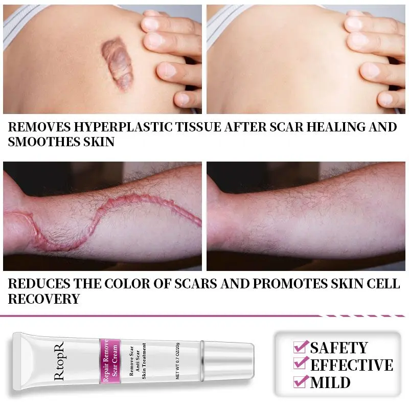 An effective anti-scar treatment