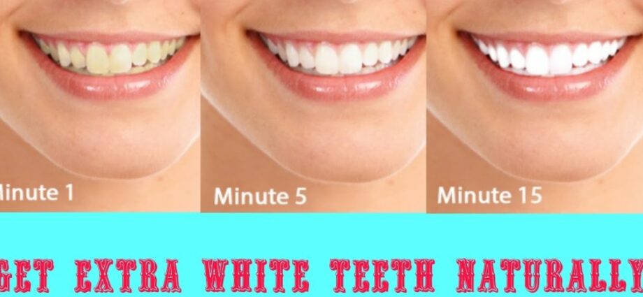 An effective way to whiten teeth without a dentist, and what doctors think about it