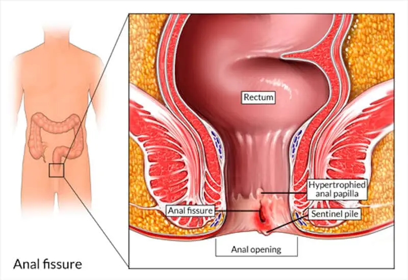 Anal fissure &#8211; Our doctor&#8217;s opinion