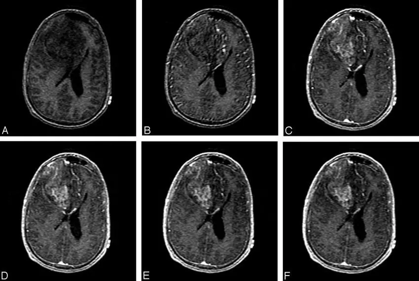 Anaplastic oligoastrocytoma: all you need to know about this glioma