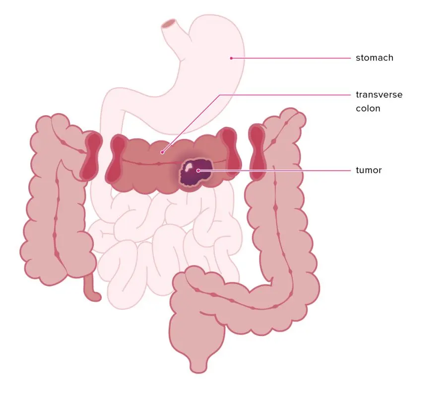 Anastomosis