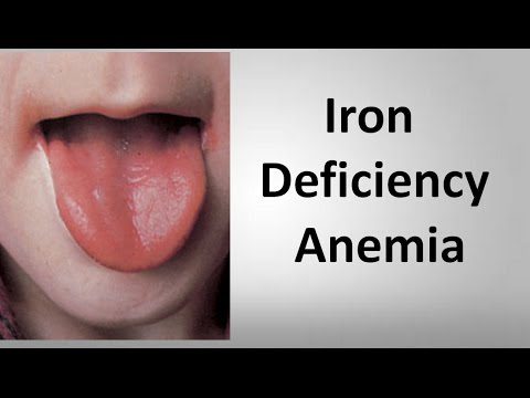 Anemia: signs of anemia. Video