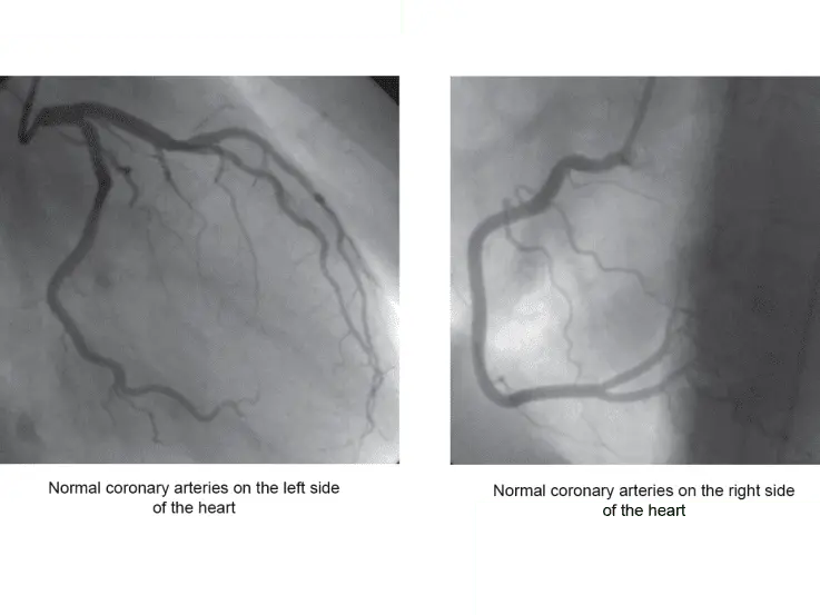 Angiography: what is it?