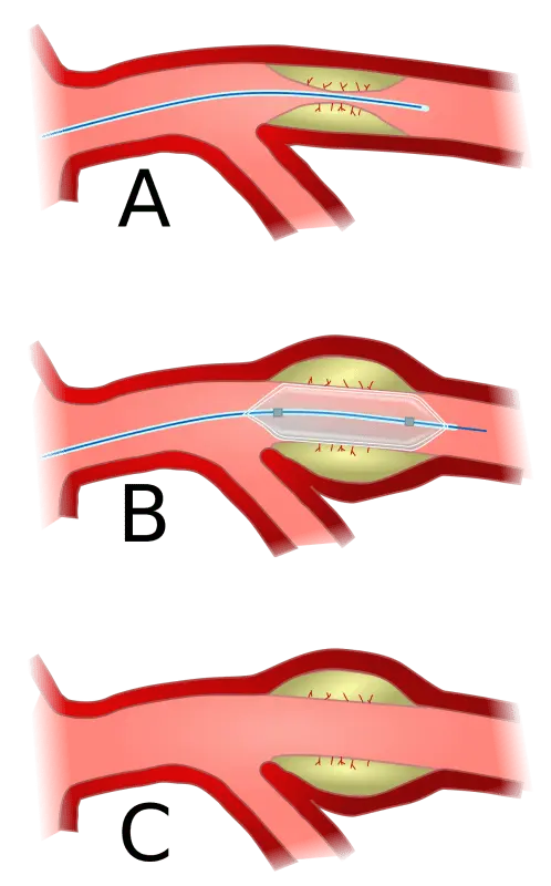 Angioplasty