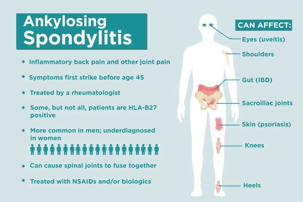 Ankylosing spondylitis (spondylitis) &#8211; Sites of interest and support groups