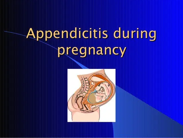 Appendicitis during pregnancy: symptoms